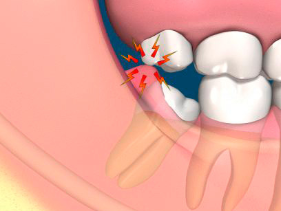 What to eat After Wisdom Tooth Removal?